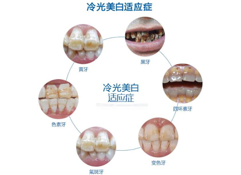 冷光美白，值得尝试的牙齿美白方法？