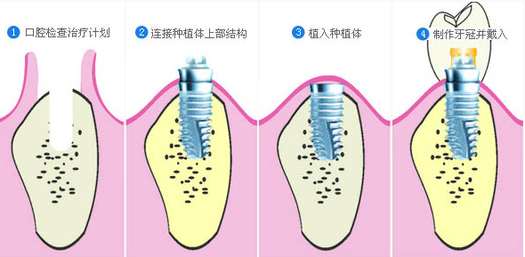 牙医不种植牙的原因与考量分析，背后的多重因素揭秘